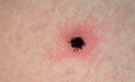 Zece persoane se prezintă, zilnic, la Urgenţe, după ce au fost muşcate de căpuşe