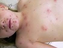 Cazuri noi de rujeola in județul Buzau