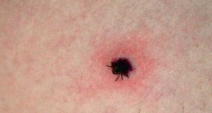 Atenție la căpușe! Buzoieni diagnosticați cu boala Lyme