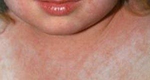 Cazul de scarlatină de la Buzău a fost confirmat