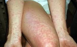 Atenţie! Suspiciune de scarlatină într-o grădiniţă din Buzău