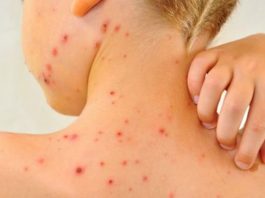 Buzăul își păstrează locul fruntaș în cazurile de rujeolă