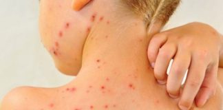 Județul Buzău, al doilea din țară ca număr de cazuri de rujeolă