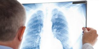 Cresc îmbolnăvirile de cancer pulmonar! 75% din totalul cazurilor, diagnosticate în stadiu inoperabil