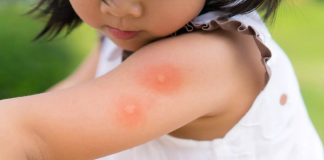 Alergia la înțepăturile de insecte. Dr. Simona Băjenaru, despre prevenție și tratament