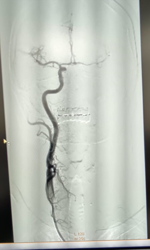 (VIDEO/FOTO) Pacientă vârstnică, salvată printr-o intervenție în premieră pentru Spitalul Județean 2 angioplastie carotidiană stent plasă antiembolică, pacientă salvată Buzău, premieră medicală Spitalul Județean Buzău, stent