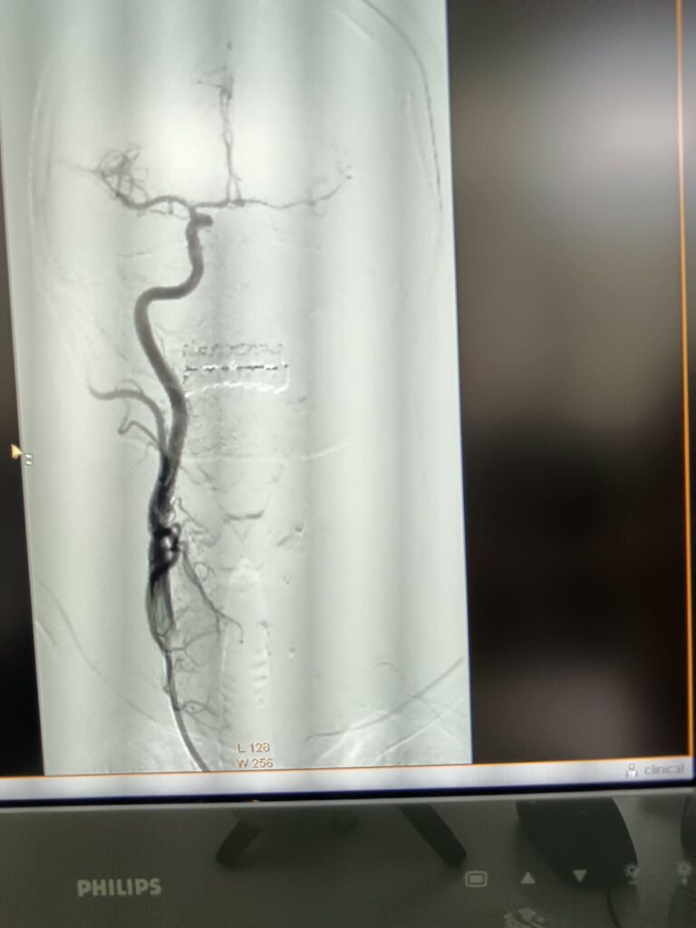 (VIDEO/FOTO) Pacientă vârstnică, salvată printr-o intervenție în premieră pentru Spitalul Județean 3 angioplastie carotidiană stent plasă antiembolică, pacientă salvată Buzău, premieră medicală Spitalul Județean Buzău, stent