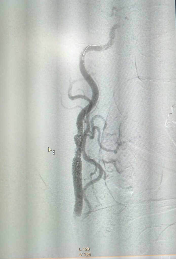 (VIDEO/FOTO) Pacientă vârstnică, salvată printr-o intervenție în premieră pentru Spitalul Județean 4 angioplastie carotidiană stent plasă antiembolică, pacientă salvată Buzău, premieră medicală Spitalul Județean Buzău, stent