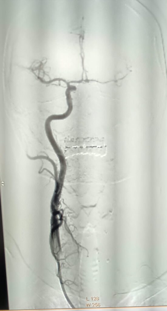 (VIDEO/FOTO) Pacientă vârstnică, salvată printr-o intervenție în premieră pentru Spitalul Județean 1 angioplastie carotidiană stent plasă antiembolică, pacientă salvată Buzău, premieră medicală Spitalul Județean Buzău, stent