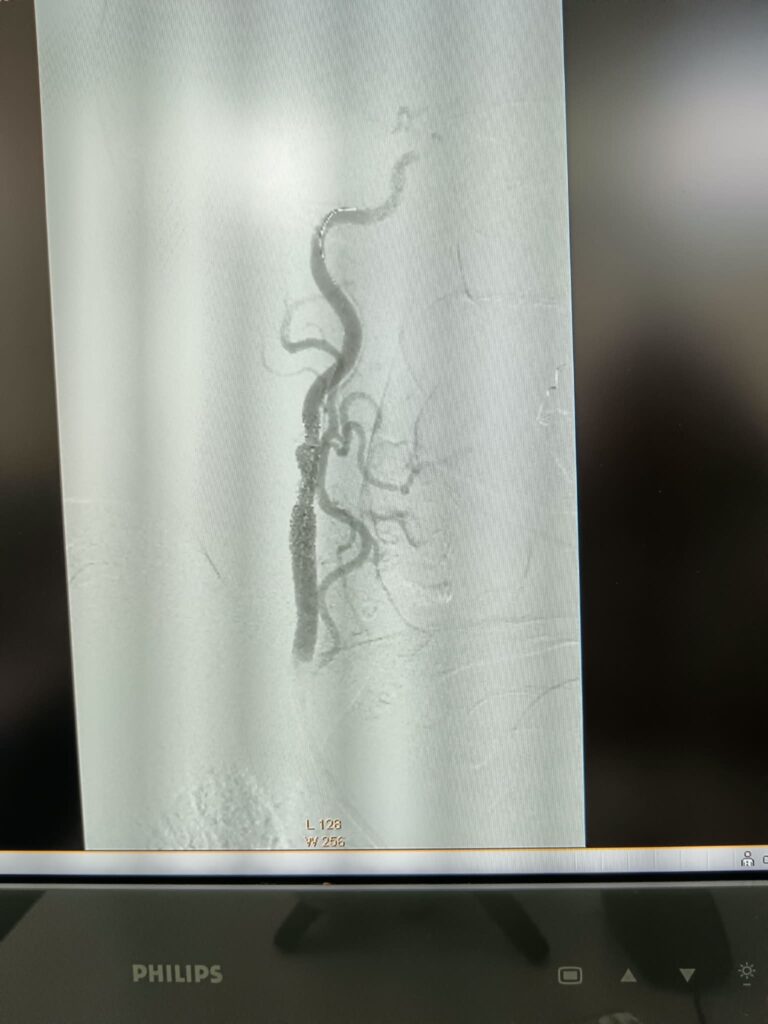 (VIDEO/FOTO) Pacientă vârstnică, salvată printr-o intervenție în premieră pentru Spitalul Județean 6 angioplastie carotidiană stent plasă antiembolică, pacientă salvată Buzău, premieră medicală Spitalul Județean Buzău, stent