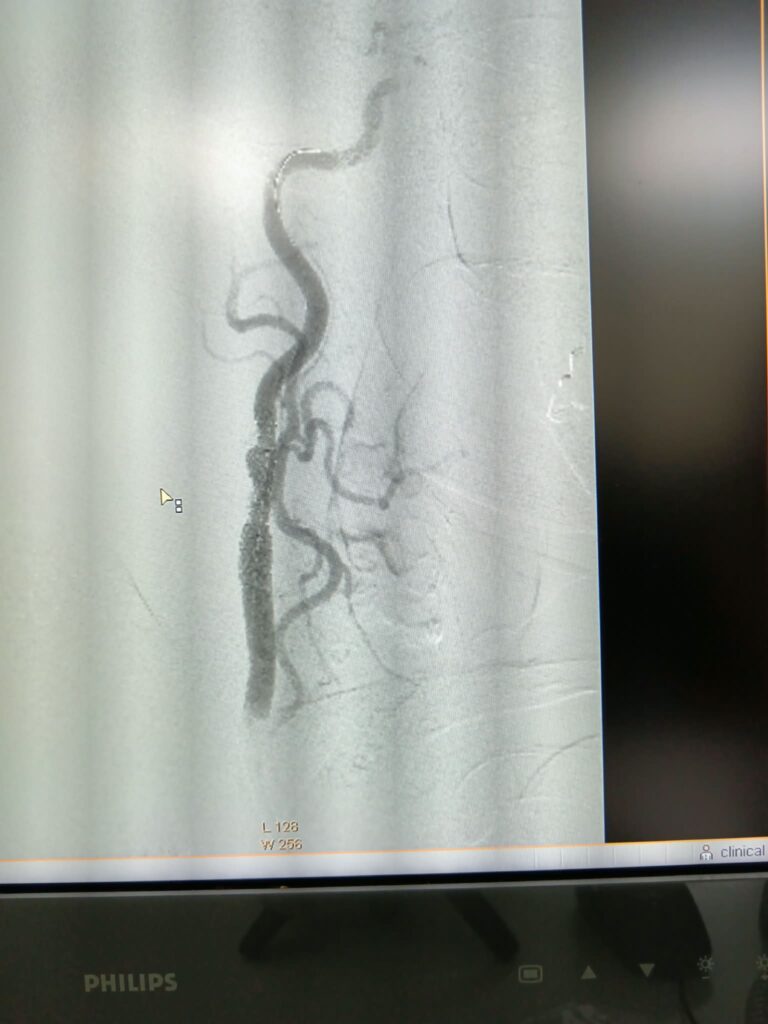 (VIDEO/FOTO) Pacientă vârstnică, salvată printr-o intervenție în premieră pentru Spitalul Județean 5 angioplastie carotidiană stent plasă antiembolică, pacientă salvată Buzău, premieră medicală Spitalul Județean Buzău, stent
